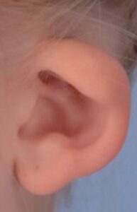 گوش فنجانی (Cup Ear)