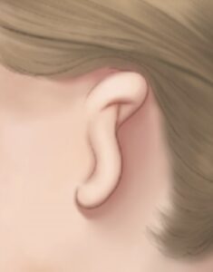 میکروشیا (Microtia)